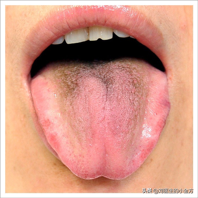舌象图解大全中医舌诊,最全中医舌诊图谱来了