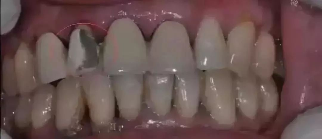 烤瓷牙对比全瓷牙有什么优点,烤瓷牙和全瓷牙哪个性价比更高