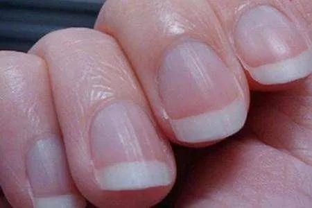 指甲月牙白少说明了什么,指甲月牙白内凹陷是病吗