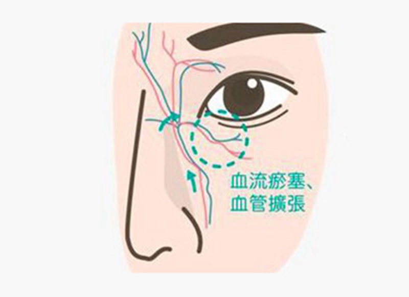 去熬夜型黑眼圈,去黑眼圈眼袋熬夜党福音