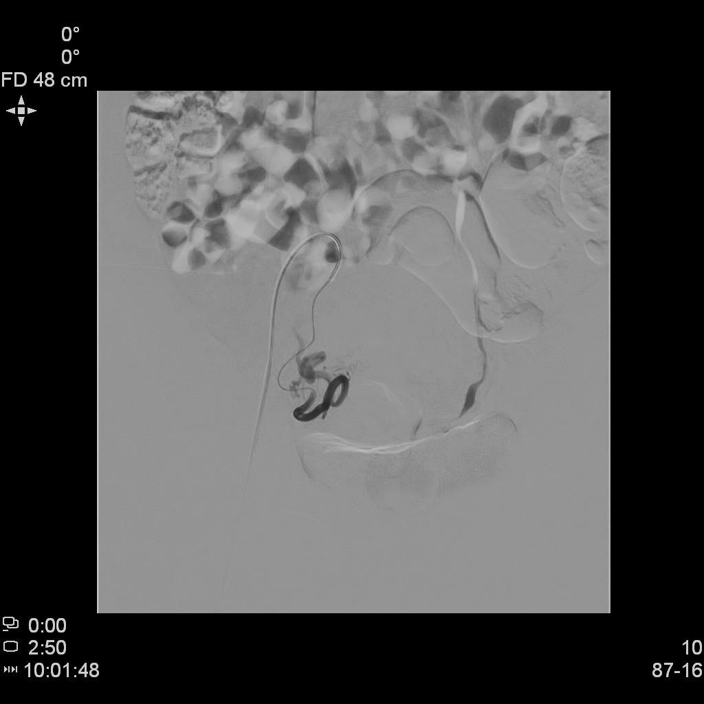 子宫肌瘤介入栓塞术排出黄水,子宫肌瘤介入消融治疗