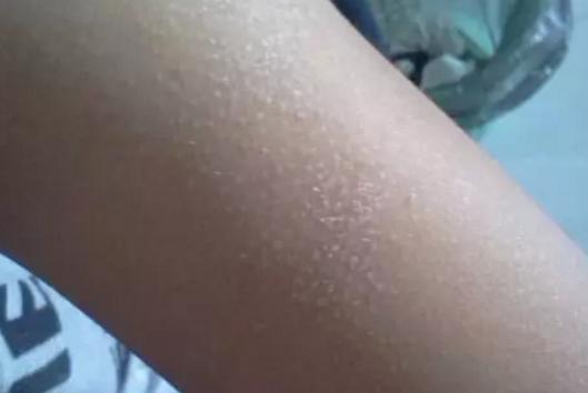 夏日不愁，4种方法拯救你的皮肤，和「鸡皮肤」说再见