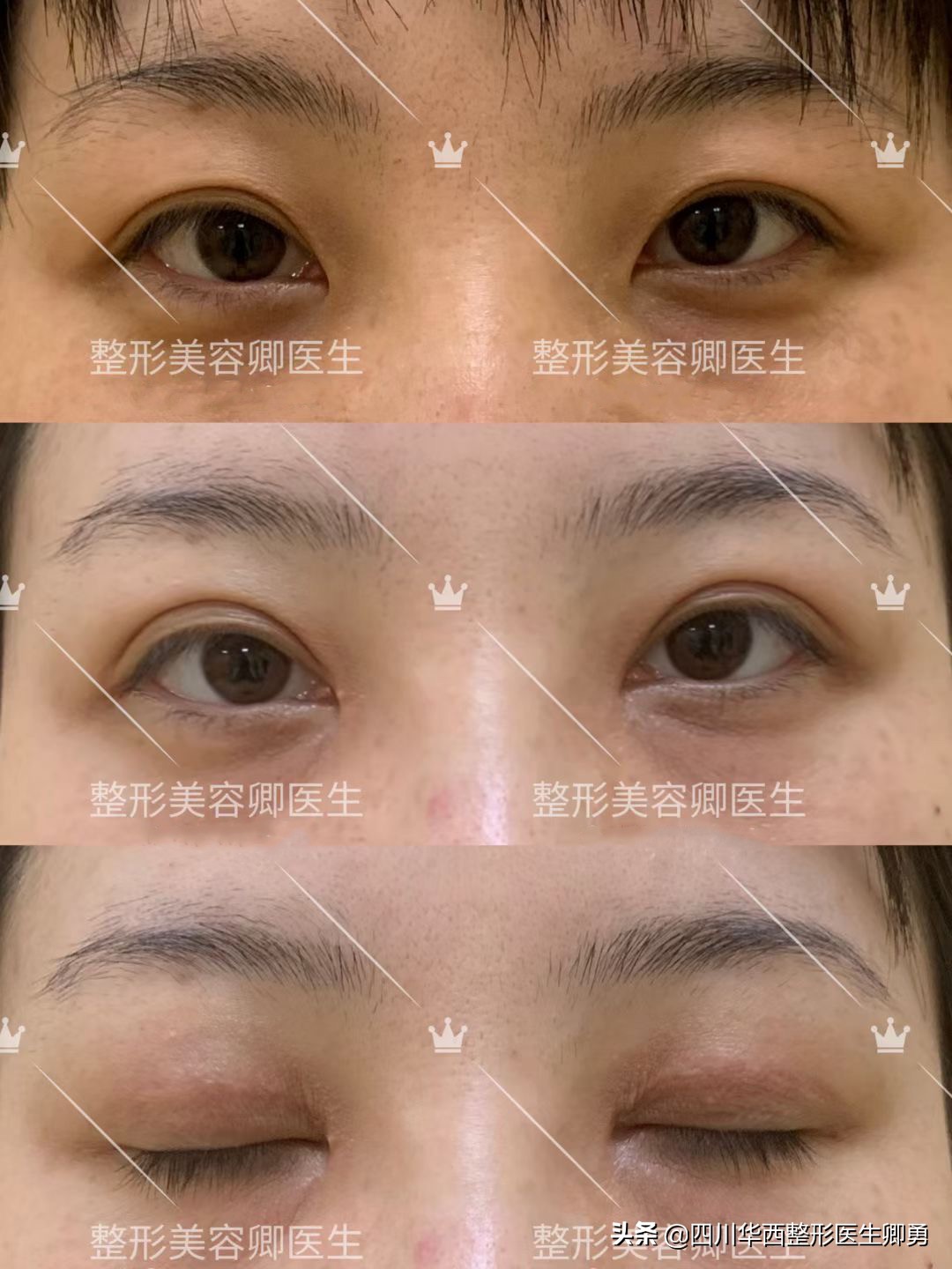 上海宇东修复双眼皮失败案例,双眼皮失败修复费用由谁承担