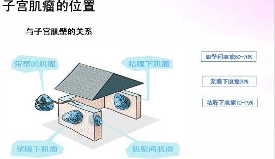 子宫肿瘤医院全国排名,子宫肌瘤分几种类型