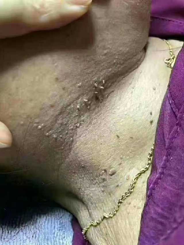 扁平疣—孕期妈妈之痛