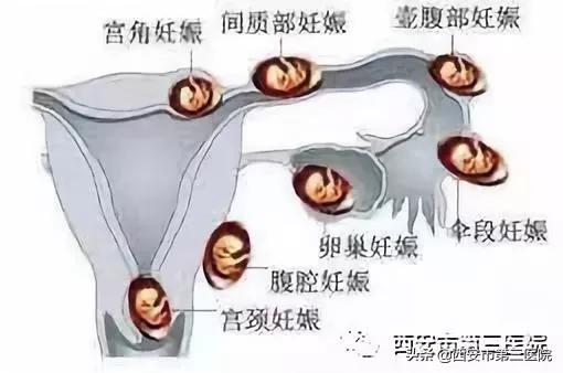 【警惕“异位妊娠”】跑偏了的“受精卵”