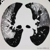 新型冠状病毒感染的肺炎患者肺部影像学改变