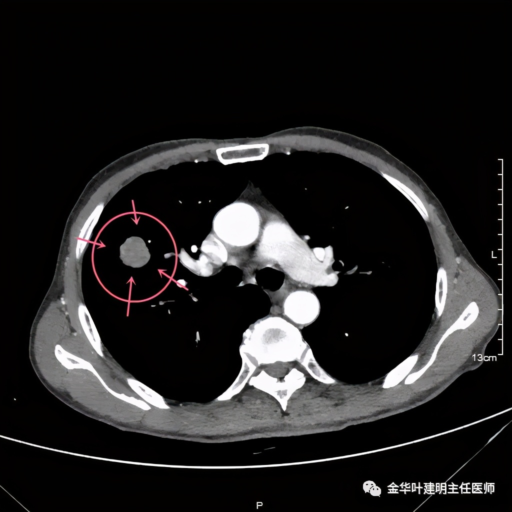 得了肺癌做肺部穿刺有影响吗,肺部穿刺可以确诊肺癌吗