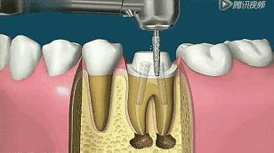 根管治疗后期症状,根管治疗全过程真的很痛吗