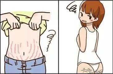 肥胖纹是不是皮肤弹性不好,肥胖纹有感觉吗