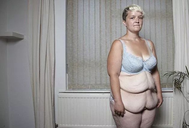 减肥后肚子皮肤松弛大概多久恢复,减肥减得太快了皮松了怎么办