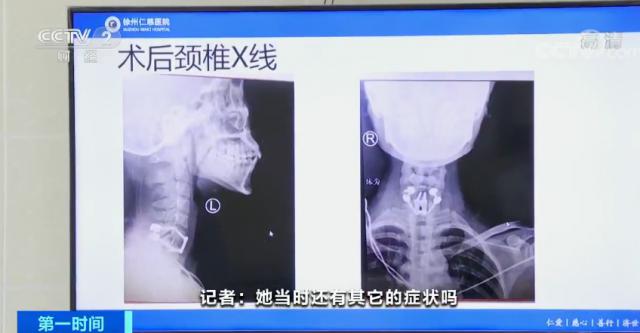 女子蹦床馆全身瘫痪,女孩玩蹦床完全性瘫痪