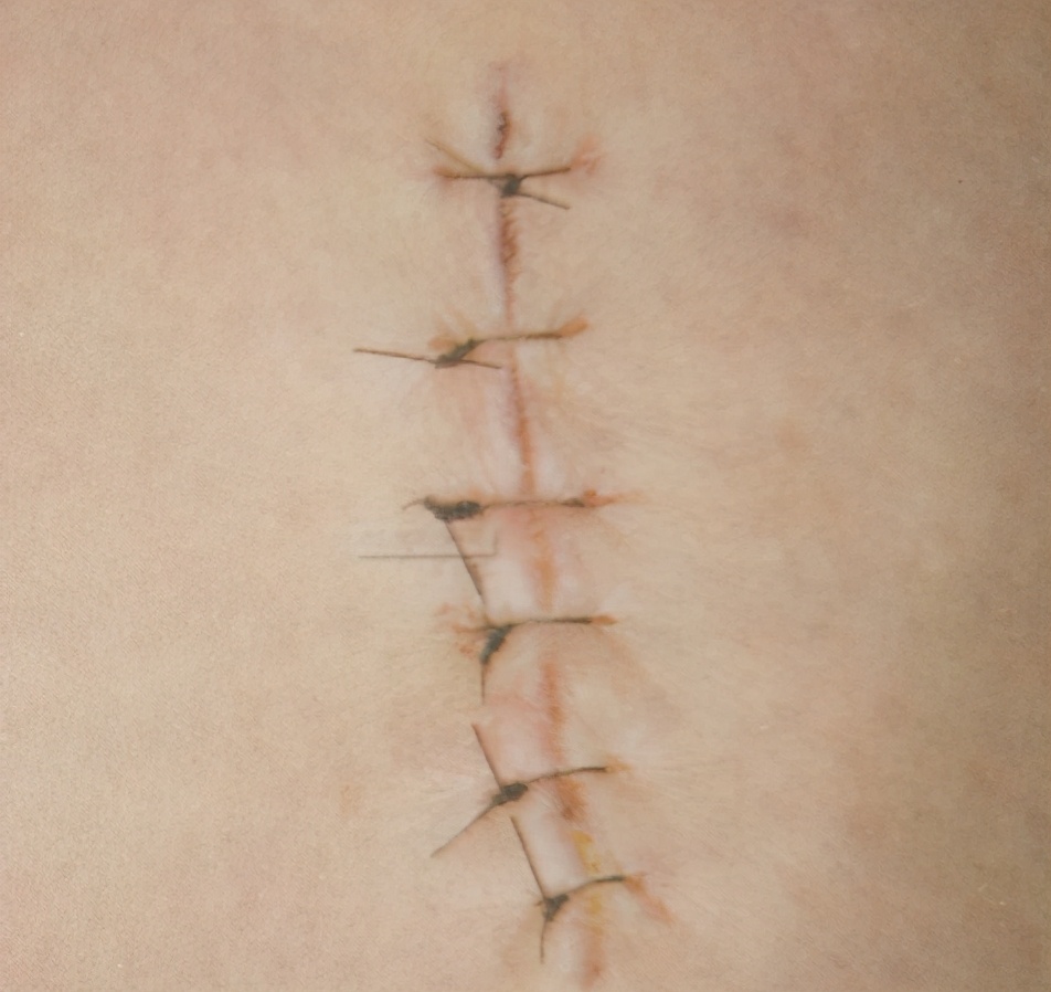 手术切口为什么会感染,什么情况下切口会感染