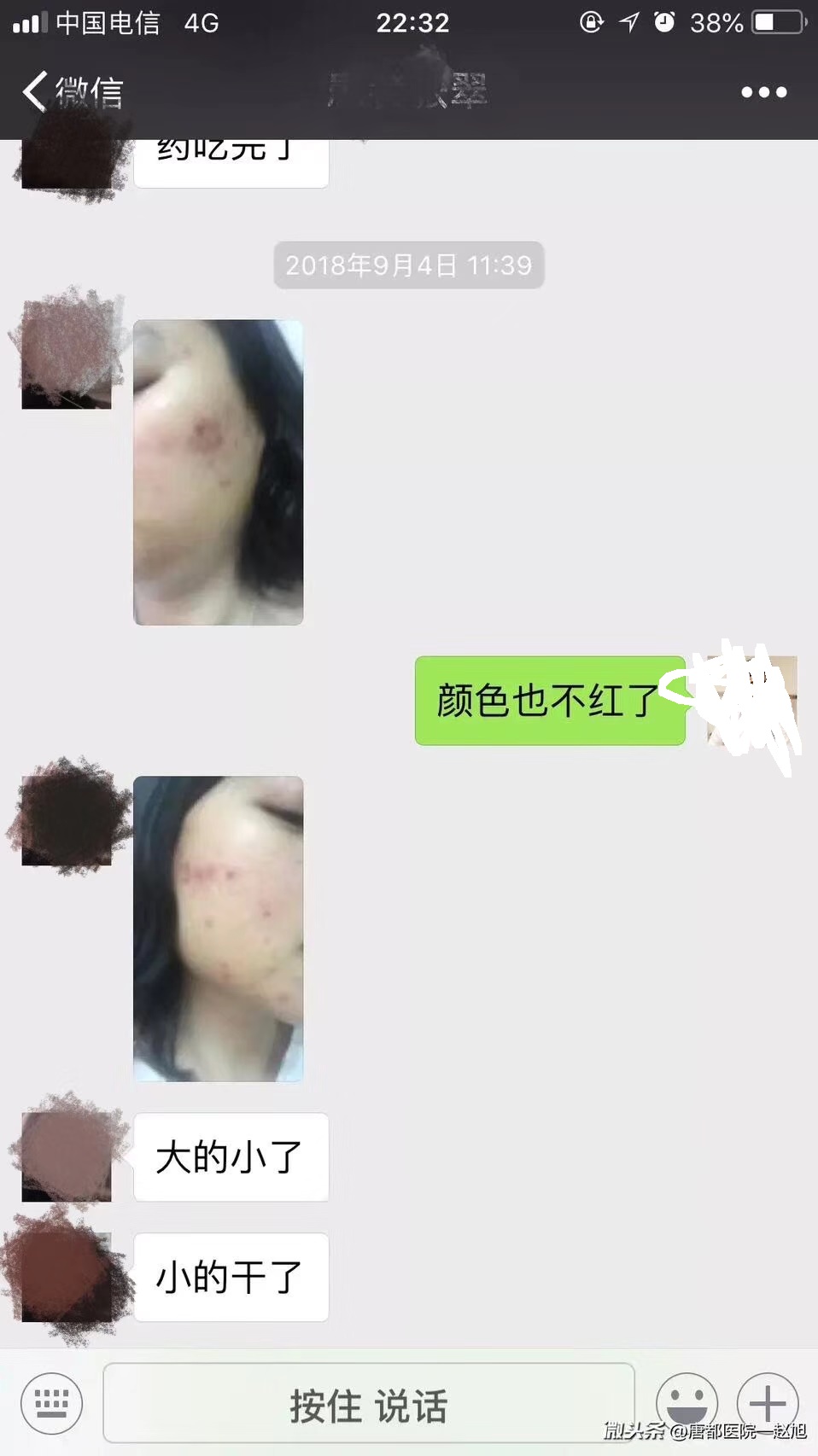脾胃湿热引起的痘痘用什么,湿热生疮多吃什么才好