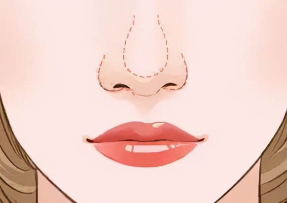 蒜头鼻的改变,蒜头鼻变挺的方法