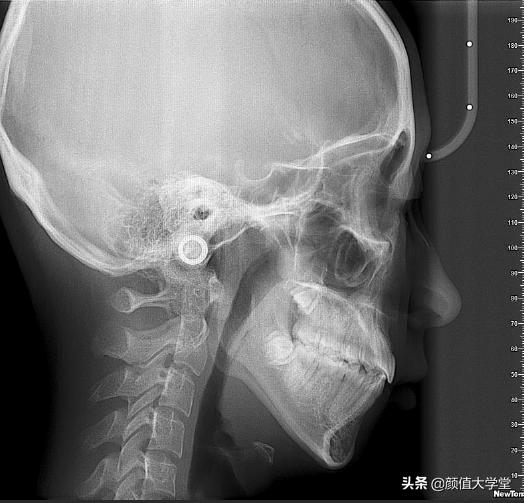 下巴后缩怎么拍侧颜,下巴后缩需要怎么矫正