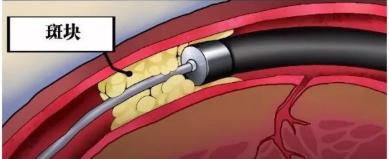 激光冠脉消蚀术,激光治疗新技术视频