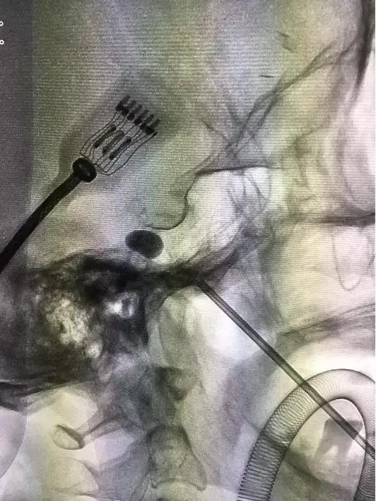 痛得拔光一排牙！解决炸裂“天下第一痛”一根套管针显乾坤