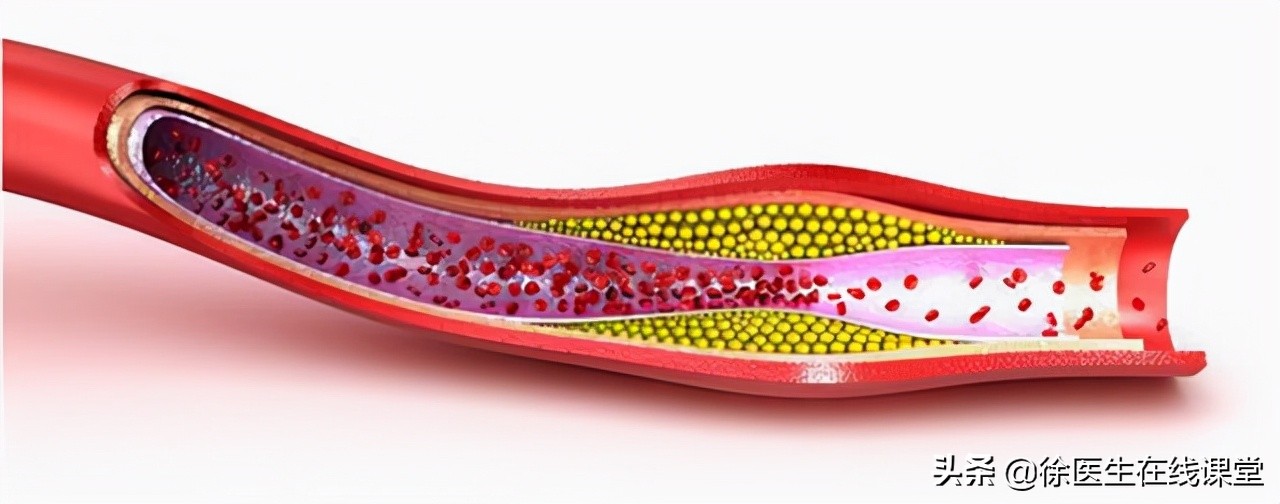 降脂药辛伐他汀和匹伐他汀区别,阿托伐他汀和瑞舒伐他汀降脂比较