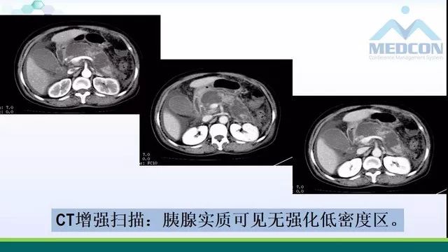 急性胰腺炎的护理措施,急性胰腺炎影像与临床