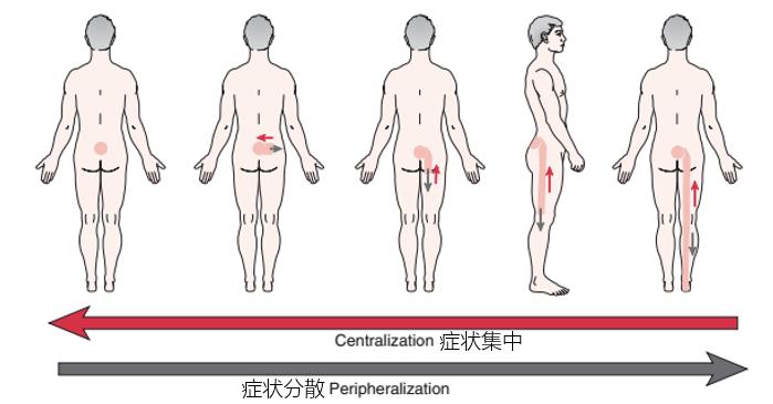 腰突导致腿麻可以保守治疗吗,如何治疗腰突引起的腿麻