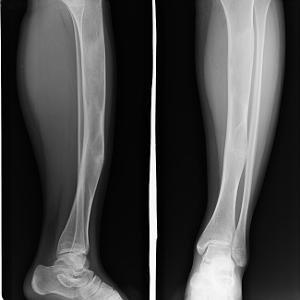 骨纤维结构不良是骨肿瘤吗？孩子高发，怎么才能发现呢？
