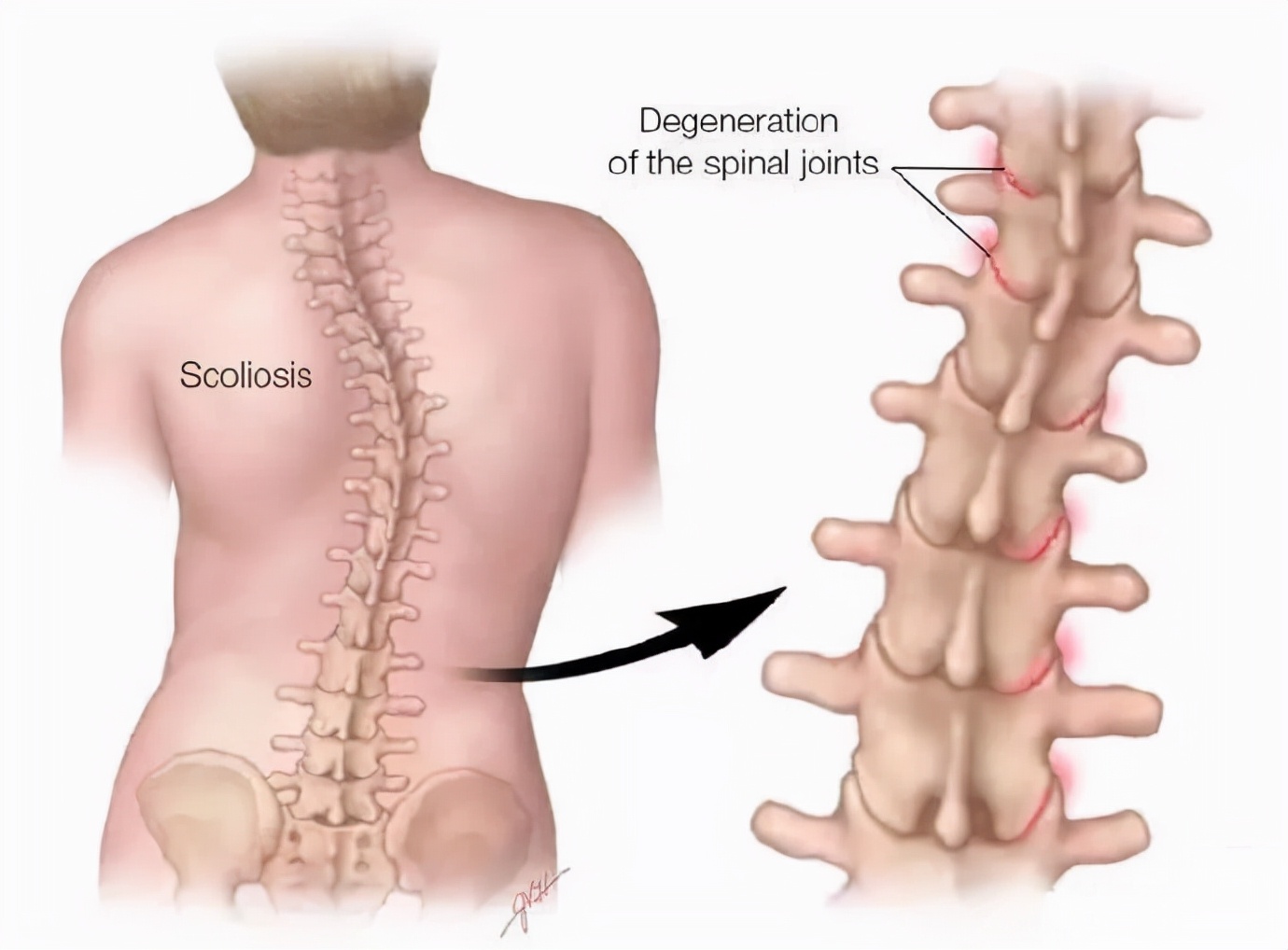 简单脊柱侧弯训练动作两个,1岁脊柱侧弯矫正动作