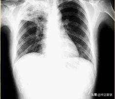 新冠肺炎咳嗽和普通咳嗽区别,咳嗽肺炎一般几天会自动治愈
