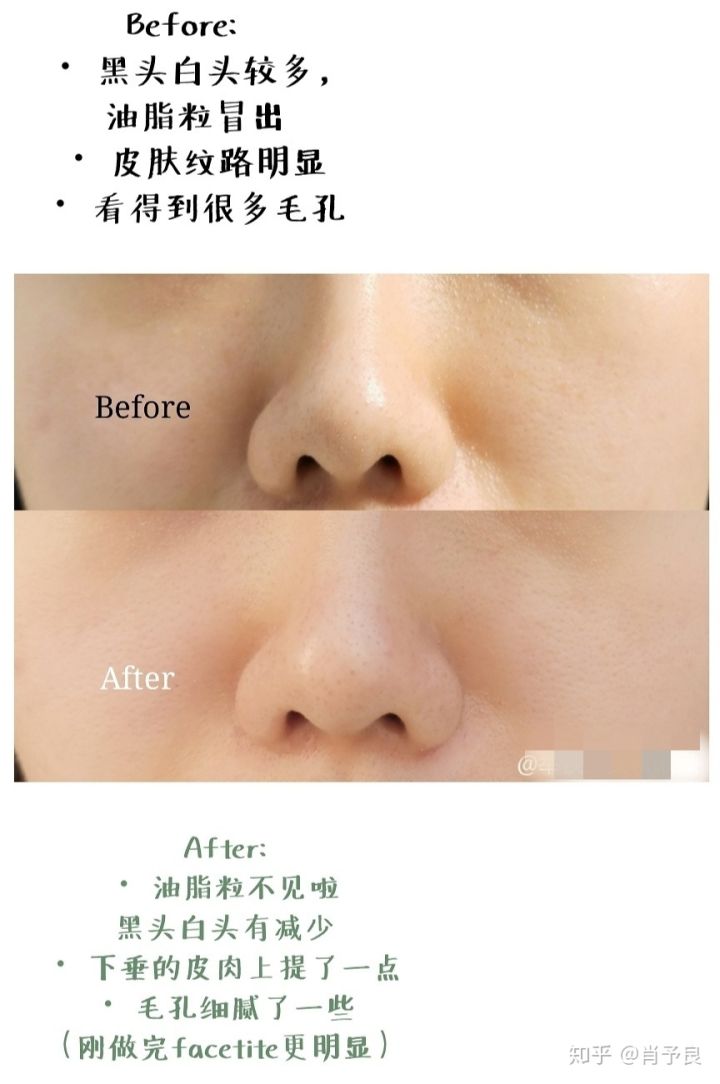 祛鼻头黑头粉刺,怎样可以祛黑头痘痘收缩毛孔