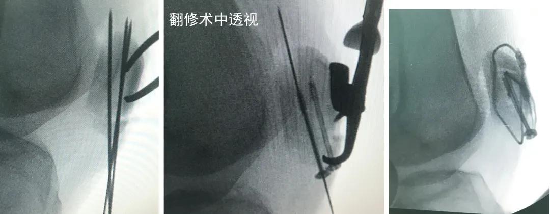 2020三院新技术|异形垫片，纵横连接——髌骨下极粉碎骨折的新选择