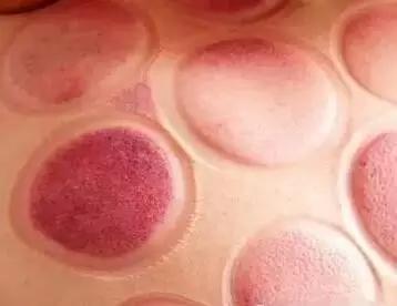 为何拔罐肩膀处罐印最深,拔罐没有罐印代表什么意思