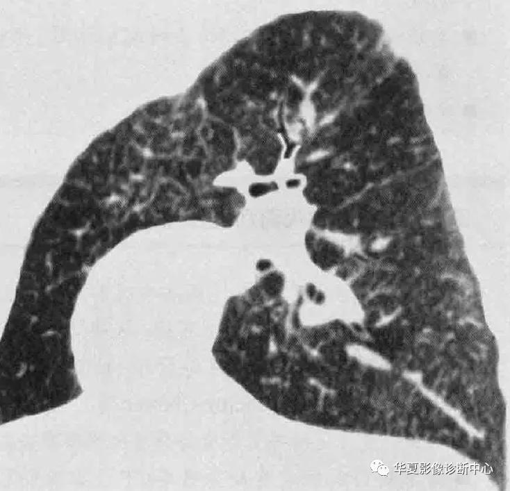 肺部代谢周期是多少天,肺部高代谢病变