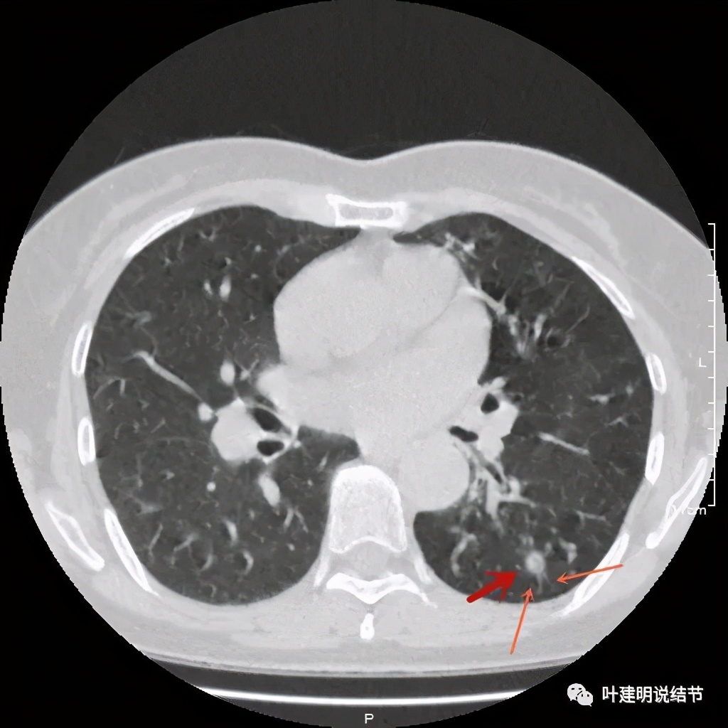 这样的实性结节伴小空洞会是肺癌吗？
