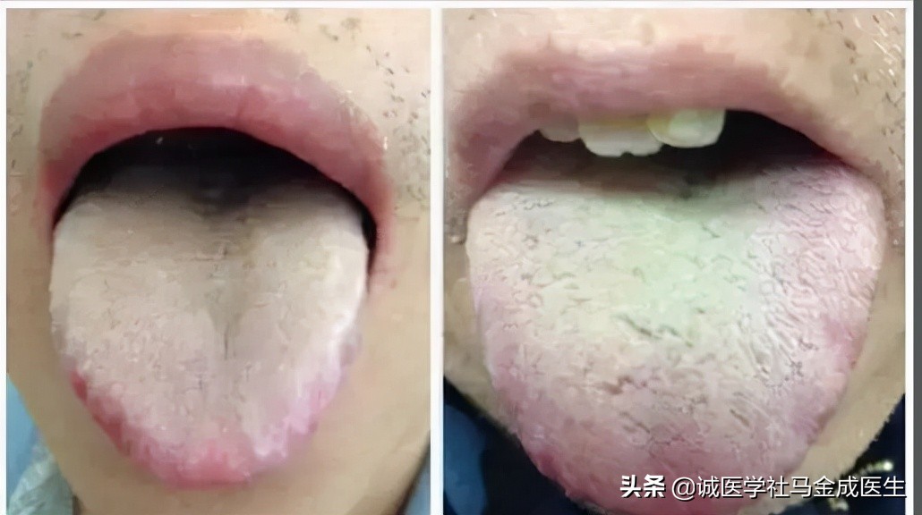 脾虚齿痕舌整天乏困吃什么中成药,治疗脾虚齿痕舌最好的中成药