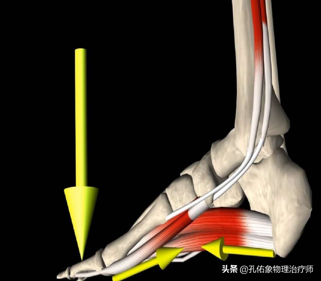 如何治疗足底筋膜炎缓解疼痛,足跟痛筋膜炎最佳的治疗办法