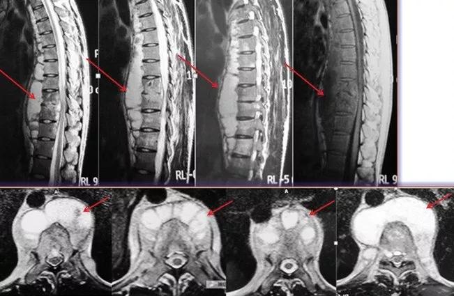 脊柱结核保守治疗大约需要多少钱,脊柱结核可以保守治疗