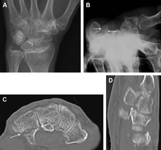 值夜班急救措施,放射科容易漏诊的骨折