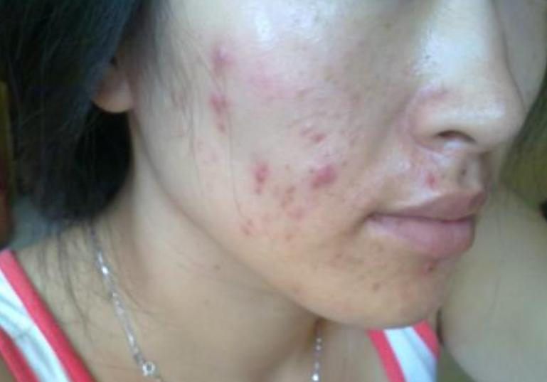 痘痘肌化妆教程化妆品,痘痘肌化妆需要哪些化妆品