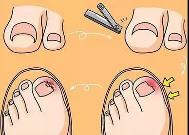 啃指甲拔倒刺危害,手指拔肉刺甲沟炎化脓怎么治