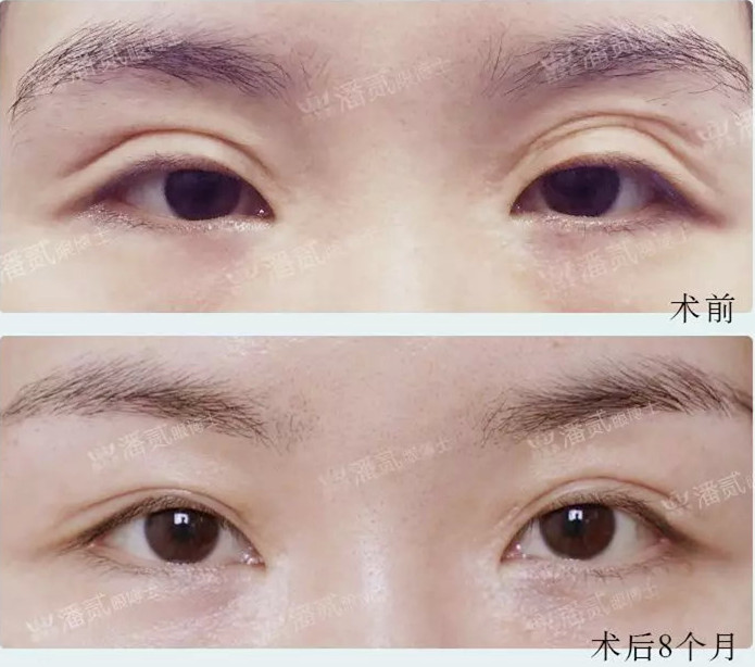 双眼皮修复有失败的吗,双眼皮修复失败了会怎样