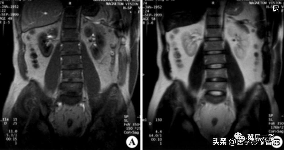 18种泌尿生殖系统常见疾病MR诊断总结