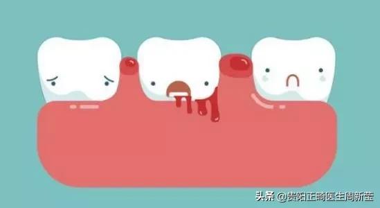 刷牙时牙龈出血怎么能有效的防护,刷牙牙龈出血只需要洗牙吗