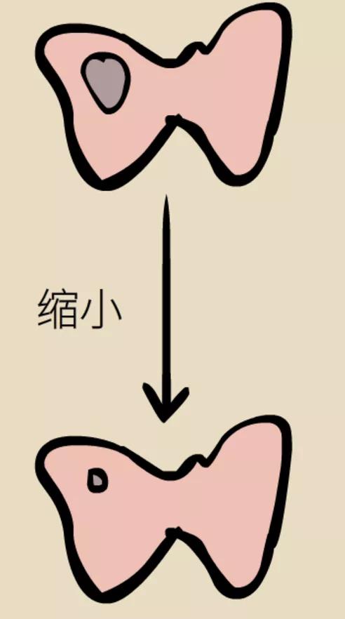 甲状腺结节频发，该拿它怎么办才好？