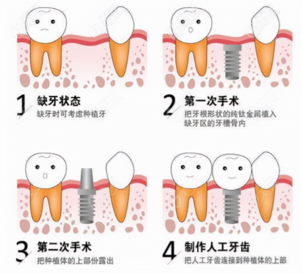 戴假牙后牙龈萎缩怎么办,戴活动假牙牙龈萎缩露牙根怎么办