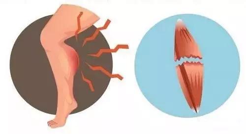 防止小腿肌肉萎缩的康复训练方法,小腿受伤了怎么恢复最快