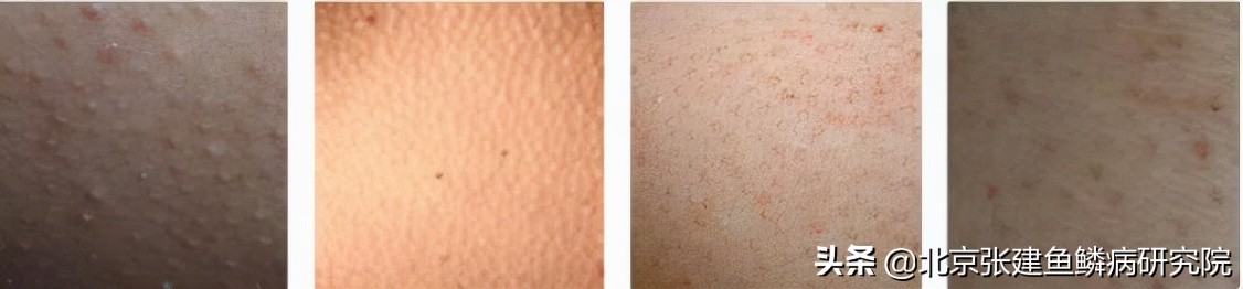 什么样的是毛囊角化症,怎么辨别毛囊是否坏死