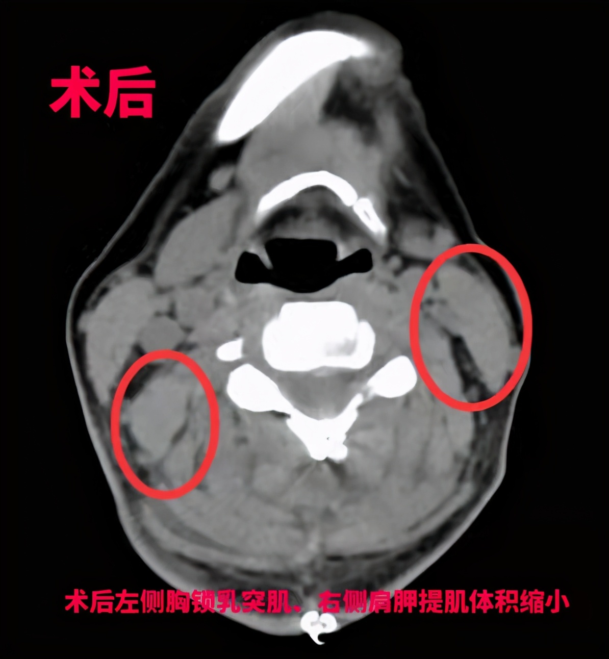 治疗歪脖,治疗脖子歪
