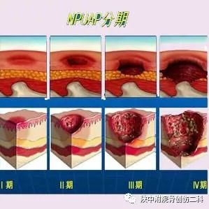 褥疮治疗?你还在每天繁琐的换药吗?