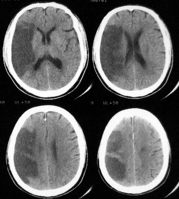 吃饭咬到腮帮怎么好得快,吃东西咬到腮帮是上火吗