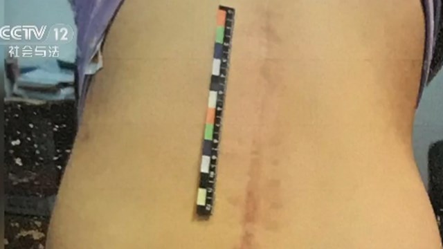 女童从17楼坠落后奇迹生还,两岁女童从18楼坠落奇迹生还